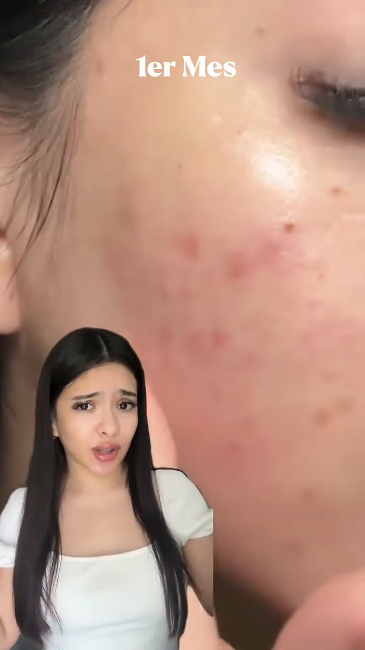 Testimonio: dos meses de uso, menos brotes y manchas