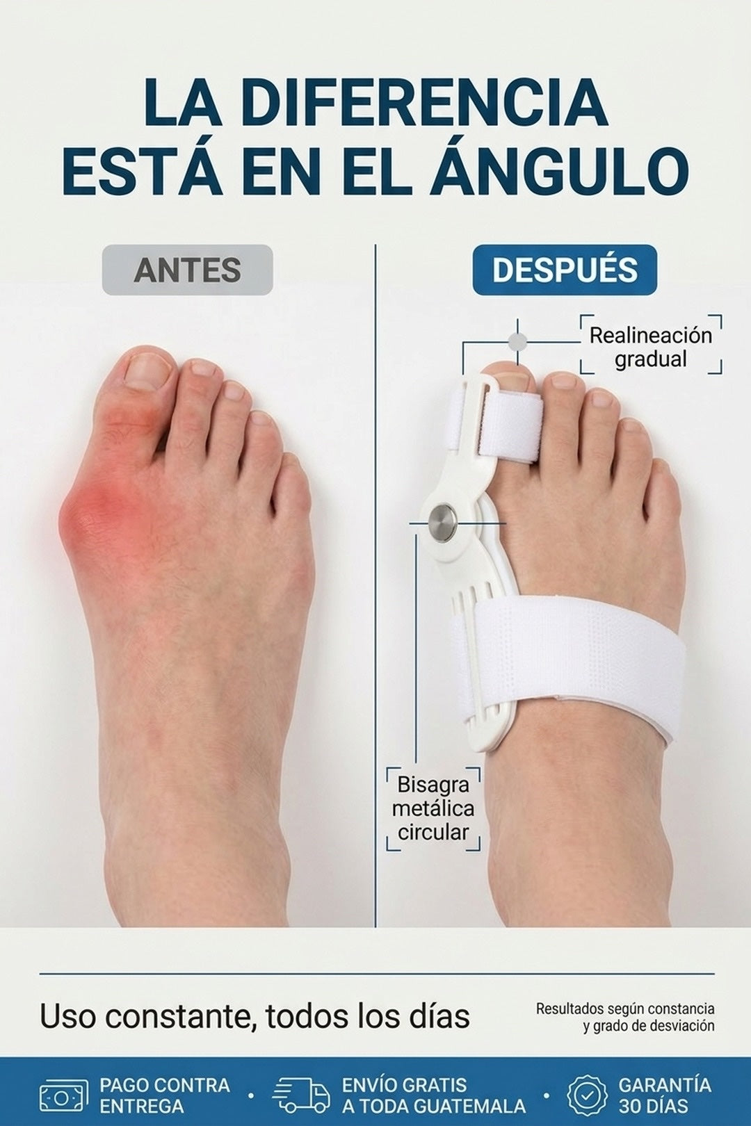 Antes y después: el dedo gordo desviado y luego alineado con el corrector puesto